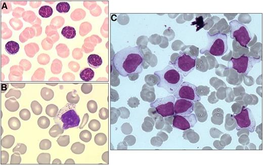 Figure 2. Blood morphology. (A) Small lymphocytes for comparison. (B and C) Typical LGLs on blood smear. Adapted with permission from Lamy and Loughran.6