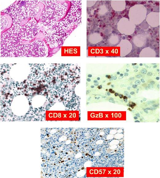 Figure 3. Marrow biopsy for immunostaining. Hematoxylin and eosin stain shows slight hypercellularity with compensatory myeloid hyperplasia. CD3 is a pan T-cell marker expressed in all stages of T-cell development. CD8 is a marker for cytotoxic T cells. GzB is a component of cytotoxic granules. CD57 is a marker of terminal differentiation when expressed on CD8+ T cells. Adapted with permission from Lamy and Loughran.6
