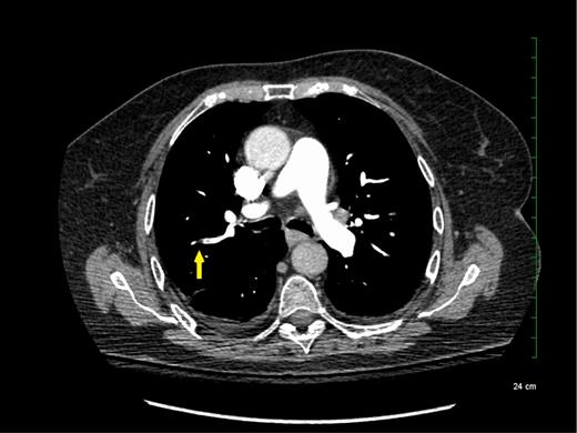 Figure 1. Subsegmental pulmonary embolism on computed tomographic pulmonary angiography.