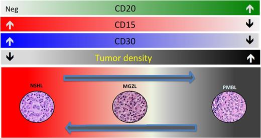 Figure 1. (A) Pathobiologic spectrum of mediastinal B-cell lymphomas. (B) Although NSHL is typically CD15 and CD30 positive, and PMBL is CD20 positive, there are mediastinal lymphomas in between these 2 entities with phenotypic and biologic features intermediate and transitional between NSHL and PMBL. These diseases are called mediastinal gray zone lymphomas (MGZLs).