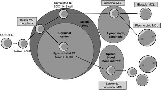 Figure 1. Model of progression of mantle cell lymphoma. Adapted with permission from Swerdlow et al.44 Original illustration by Patrick Lane.