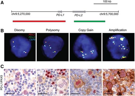 Figure 3. Genetic and immunohistochemical analyses of the PD-L1 and PD-L2 loci. (A) Location and color-labeling of the BAC clones on 9p24.1 used for FISH. RP11-599H20 including PD-L1, labeled red. RP11-635N21 including PD-L2, labeled green. (B) Representative images of FISH results for the different categories. PD-L1 in red, PD-L2 in green, fused (F) signals in yellow and centromeric probe (CEP9) in aqua (A). In these images, disomy reflects 2A:2F; polysomy, 3A:3F; copy gain, 3A:6F; and amplification, 15+F. (C) PD-L1 (brown)/PAX5 (red) immunohistochemistry in the cHL cases with 9p24.1 disomy, polysomy, copy gain, and amplification from panel B. Scale bar indicates 50 μm. Reprinted with permission © (2016) American Society of Clinical Oncology. All rights reserved. Roemer, MG et al: J Clin Oncol Vol. 34 (23), 2016 2690-7.