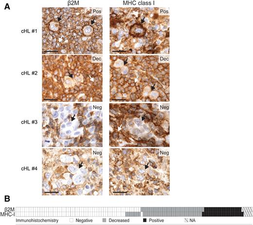 Figure 4. β2M, MHC class I, and MHC class II expression in cHL patients. (A) β2M and MHC class I immunohistochemical staining in 4 representative cHL patients: #1, positive for both markers (Pos); #2, decreased for both markers (Dec); #3 and #4, negative for both markers (Neg). Individual HRS cells are depicted with a black arrow. The white arrows indicate expression on surrounding, nonmalignant inflammatory cells. Scale bar, 50 μm. (B) Heat map representing the distribution of β2M and MHC class I (MHC-I) expression in the 108 cHL patients. White, negative; gray, decreased; black, positive; hatched, not assessable (NA). Reprinted with permission from Cancer Immunology Research 2016; 4: 910.