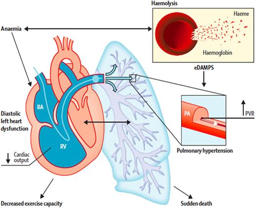 Figure 4. How chronic intravascular hemolysis leads to precapillary pulmonary arterial hypertension (PAH) and pulmonary arteriole vaso-constriction and smooth muscle hypertrophy, and how chronic anemia leads to diastolic left heart disease (now also called HFpEF). These 2 disease manifestations are diagnosed by using Doppler echocardiography and right heart catheterization. PVR, pulmonary vascular resistance; RA, right atrium; RV, right ventricle. Reprinted from The Lancet, 387, Gladwin MT, Cardiovascular complications and risk of death in sickle cell disease, 2565-2574, 2016, with permission from Elsevier.