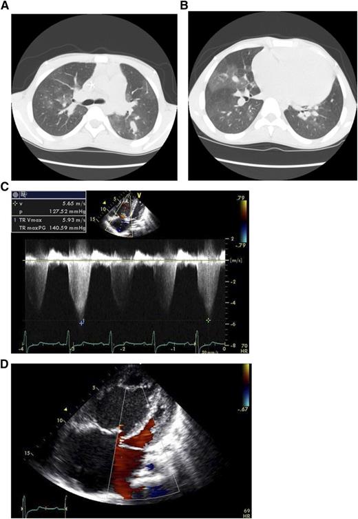 Figure 1. Imaging from an 18-year-old male patient with homozygous hemoglobin SS disease. (A,B) CT scan demonstrating large pulmonary artery and mosaic perfusion pattern due to areas of higher radiodensity where the blood flow is high (more white), next to darker areas where the pulmonary arterioles are narrowed and blood flow is reduced. (C) Doppler echocardiographic study records a very high tricuspid regurgitant jet velocity (TRV) of 5.93 m/s, which estimates a pulmonary artery systolic pressure of greater than 140 mm Hg. (D) Four-chamber view of his heart shows shows a dilated right ventricle (RV) and right atrium (RA) with a compressed left ventricle (LV).
