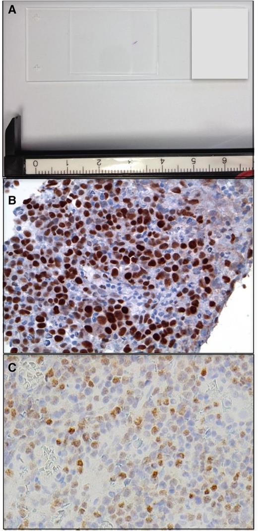 Figure 1. PCNSL at diagnosis. (A) Example of a stereotactic brain biopsy used to diagnose DLBCL involving the corpus callosum in PCNSL. The diagnostic specimen is <2 mm in length. (B) Example of MYC protein expression, detected by immunohistochemistry in a diagnostic PCNSL brain biopsy (with diaminobenzidine detection). High expression of MYC is detected with increased frequency in PCNSL (∼50% of cases) compared with systemic DLBCL (original magnification ×40). (C) IRF-4/MUM-1 is expressed in >90% of PCNSL (original magnification ×40).