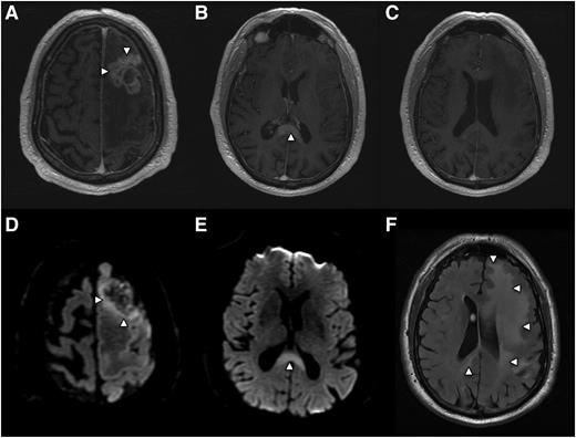 Figure 2. Radiographic presentation of multifocal PCNSL, characterized by distinct MRI sequences. (A) T1 postgadolinium image demonstrates an enhancing mass involving the left frontal lobe (arrows) with central necrosis and surrounding vasogenic edema. On spectroscopy the mass demonstrated increased tumor metabolites, lactate, and choline (not shown). (B) An apparently isolated, second homogeneously enhancing mass (arrow) is identified inferiorly, involving splenium of the corpus callosum. (C) No enhancing foci are detected in white matter between the 2 distinct lesions. (D) Diffusion-weighted imaging demonstrates foci of reduced or restricted diffusion (arrows), suggestive of dense cellularity, in the superior aspect of the frontal mass. (E) Restricted diffusion within the enhancing lesion involving the corpus callosum, strongly suggestive of lymphoma. (F) Extensive T2/FLAIR signal hyperintensity (arrows) extending from the frontal mass posteriorly to the corpus callosal lesion, consistent with nonenhancing lymphoma dissemination involving the cerebral hemisphere.