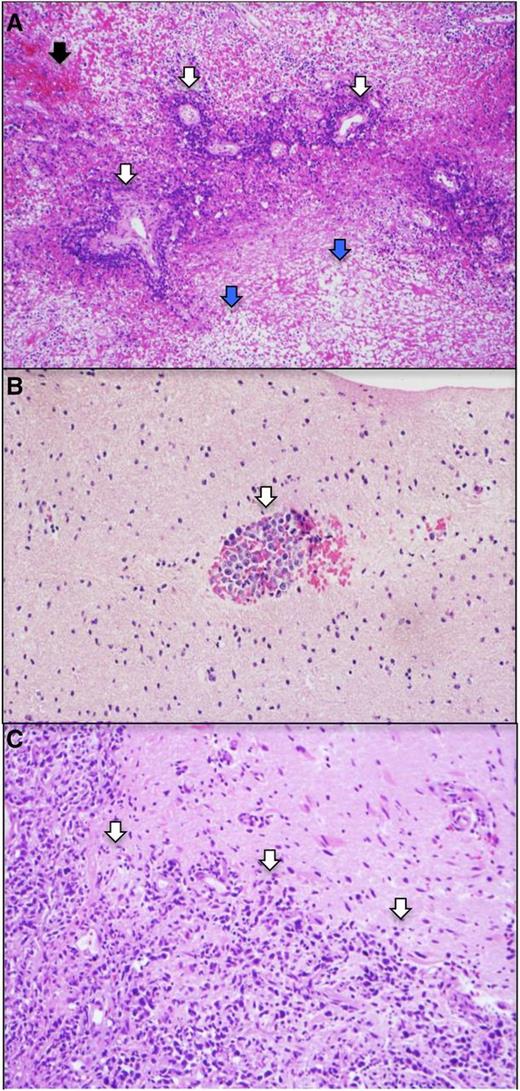 Figure 3. Two patterns of tumor invasion identified in the diagnostic PCNSL specimen (subtotal resection) from the patient in Figure 2. Hematoxylin and eosin (×10). (A) In a background of necrosis (blue arrows), and hemorrhage (black arrow) angiotropic growth of viable DLBCL (white arrows), in which lymphoma cells appear to coopt brain vasculature. (B) In a separate area containing predominantly normal brain elements, angiotropic lymphoma cells (white arrow) are noted within the perivascular (Virchow-Robin) space. (C) A second pattern is direct invasion, for example, into the meninges (white arrows).