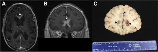 Figure 4. PCNSL at relapse with periventricular and subependymal invasion. Common patterns of relapse are within the vitreoretinal compartment and subependymal growth into the periventricular space, leading to spread within CSF pathways. (A and B) T1 axial postgadolinium images of PCNSL that progressed after 3 cycles of HD-MTX: Contrast-enhancing disease is evident, involving the anterior commissure of the corpus callosum. (C) Brain autopsy, obtained 1 week after the MRI, confirmed periventricular DLBCL with subependymal spread.