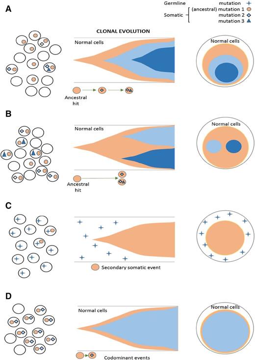 Figure 2. Clonal architecture and types of mutational events, including ancestral and subclonal mutations. Somatic ancestral events are the only clones (A-B) followed by secondary events. (A) Linear evolution with a secondary subclone. (B) Branching evolution with 2 subclones. (C) Ancestral event occurs in germ line mutations and is nonclonal. The somatic hits are subclonal. (D) Codominant events occurring in close succession and thereby not distinguishable by VAF as a primary vs secondary hit.