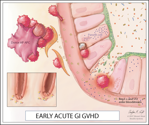 Figure 1. Early acute GI GVHD. At steady state, ISCs and Paneth cells are adjacent at the base of the intestinal crypts. Homeostasis is maintained, in part, by large numbers of commensal bacteria that stimulate IL-22 production by ILC3s. During GVHD, activated donor T cells recognize histocompatibility antigens on both hematopoietic (HP) and nonhematopoietic antigen-presenting cells (APCs). Activated APCs and T cells trigger the release of alarmins, such as IL-33, that bind to its receptor ST2; soluble ST2 (both bound to IL-33 and unbound) can enter the villus capillaries. Activated donor T cells destroy ILC3s, Paneth cells, and ISCs, releasing REG3A that was stored in the mucus and Paneth cells into the bloodstream as the epithelial barrier is breached.