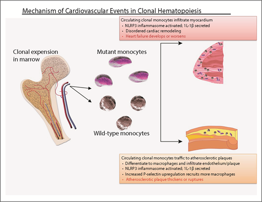 Figure 1. Probable mechanism of cardiovascular injury associated with clonal hematopoiesis. Mutant HSC-derived monocytes circulate and are recruited to plaques in arteries. There, they differentiate into tissue macrophages, which promote inflammation. The inflammasome activates IL-1β, which, in turn, promotes local inflammation, accelerating atherosclerosis, as well as induces expression of the P-selectin glycoprotein, which, in turn, recruits more monocytes (clonally derived and wild-type). Clonally derived platelets may also play an important role. In addition, increased interleukin-1β secretion in endothelial cells within the myocardium promotes disordered remodeling that potentiates heart failure.