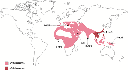 Figure 3. Prevalence and distribution of the mutations leading to α-thalassemia globally. Prevalence varies locally, hence the range of values.