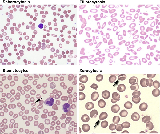 Figure 2. Peripheral blood smears in red cell membrane disorders. HS with marked spherocytic red cells (top left). HE with marked red cell fragmentation (top right). Hereditary OHS with stomatocytic red cells (bottom left). HX with a few target cells and variable number of stomatocytes (bottom right). Images adapted from ASH Image Bank.