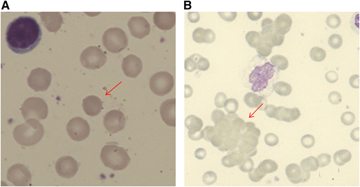 Figure 1. Blood film appearances in patients with AIHA (both using May Grunwald Giemsa stain). (A) Spherocyte in a patient with warm AIHA (original magnification, ×100). (B) Red cell agglutination in a patient with cold agglutinin disease (×40).