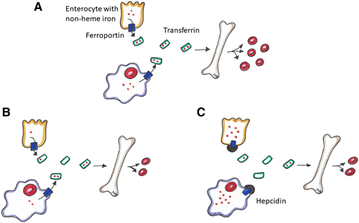 Iron homeostasis. (A) Normal metabolic pathway of non-heme iron through dietary absorption across the enterocyte and red blood cell (RBC) recycling by macrophages. Non-heme iron is transported across ferroportin, bound to transferrin and transported to the bone marrow to promote erythropoiesis. (B) Iron metabolism in an absolute iron-deficient state. There is less iron to transport to the bone marrow resulting in decreased erythropoiesis. (C) Iron metabolism in a functional iron-deficiency state. Hepcidin disables ferroportin, thus sequestering iron in the enterocyte and macrophage resulting in decreased erythropoiesis.
