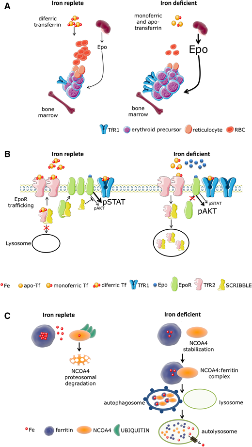 Model of iron regulation in replete and restricted erythropoiesis. (A) In the iron-replete condition, small amounts of Epo induce proliferation and differentiation of erythroblasts that take up iron by binding diferric transferrin at TfR1 for Hb synthesis. During iron deficiency, circulating transferrin is either devoid of iron (apotransferrin) or bound to iron at only 1 binding site (monoferric transferrin) with a significantly decreased concentration of diferric transferrin. Thus, in addition to less iron uptake owing to a decrease in diferric transferrin and resulting in a decrease in Hb synthesis per cell, iron restriction decreases Epo responsiveness, modifying Epo receptor–dependent signaling to support cell viability in excess of erythroid proliferation and differentiation. (B) In iron-replete conditions, diferric Tf binding to TfR2 prevents trafficking of TfR2-associated vesicles to lysosomes, enabling “free” SCRIBBLE to promote efficient EpoR surface presentation and normal Epo responsiveness. In iron-deficient conditions, TfR2-associated vesicles traffic predominantly to lysosomes, accelerating catabolism of TfR2-Scribble complexes and resulting in impaired Scribble-mediated EpoR delivery to the cell surface. Because SCRIBBLE suppresses AKT signaling, STAT5-dependent signal predominates in iron-replete conditions, supporting erythroid differentiation. In contrast, trafficking of Scribble to the lysosome in iron-deficient conditions results in persistent AKT signaling, impeding erythroid differentiation. (C) Nuclear receptor coactivator 4 (NCOA4) is a selective cargo receptor for autophagic ferritin turnover, critical for regulation of intracellular iron availability. In iron-replete states, NCOA4 binds iron, undergoes ubiquitination, and is targeted to the proteasome for degradation. In iron-deficient conditions, NCOA4 is stabilized and participates in trafficking ferritin to the lysosome, enabling iron release from ferritin and transport to the mitochondria for heme synthesis. This orchestration of erythropoiesis in parallel with iron availability prevents the proliferation and differentiation of erythroblasts when there is insufficient iron to support commensurate Hb synthesis and protects from replication stress in the absence of adequate iron. The mechanisms involved are beginning to come to light. AKT, protein kinase B; EPO, erythropoietin; EpoR, erythropoietin receptor; Fe, iron; NCOA4, nuclear receptor coactivator 4; RBC, red blood cell; STAT, signal transducer and activator of transcription; Tf, transferrin; TfR, transferrin receptor.