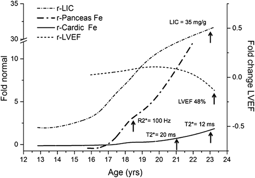 Temporal partitioning of total body iron (LIC) into pancreas and heart in a chronically transfused patient who was minimally adherent to chelation. Measurements of the organ iron by MRI iron are plotted (left axis) as fold change relative to normal. Note that the LIC is already 4 times normal at age 13 years. The pancreas iron (nl = 27 Hz) reaches the level associated with glucose intolerance (100 Hz) at 18.8 years of age, well before the cardiac T2* drops below 20 ms at about 21 years. The cardiac iron starts to rise at 18 years. The LVEF by MRI drops at age 23 years (from Coates and Wood,24 with permission).