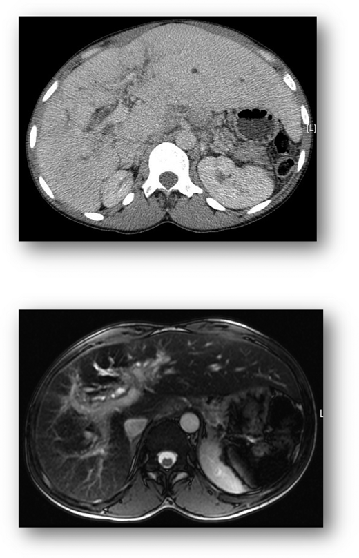 Cross-sectional imaging. CT liver (top) demonstrates hepatomegaly and irregular liver outline suggesting established chronic liver disease. MRI of the liver (bottom) shows diffuse injury of the intrahepatic bile ducts, indicative of an established cholangiopathy