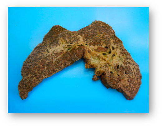 The explanted liver.