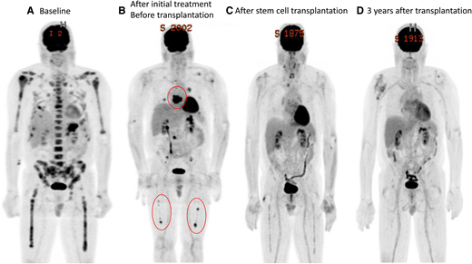 (A) Baseline. (B) After initial treatment before transplant. (C) After stem cell transplant. (D) Three years after transplant.