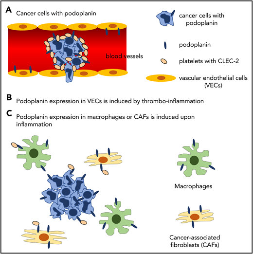 Hypothetical molecular mechanisms by which podoplanin induces cancer-associated thrombosis. (A) Podoplanin expressed on the surface of cancer cells activates platelets by binding to platelet CLEC-2 in the bloodstream. (B) Thromboinflammation induces expression of podoplanin in vascular endothelial cells, where podoplanin is not expressed in physiological status. (C) Podoplanin expression is induced in inflammatory macrophages and cancer-associated fibroblasts by inflammatory cytokines, although direct evidence shows that podoplanin in these cells activates platelets.