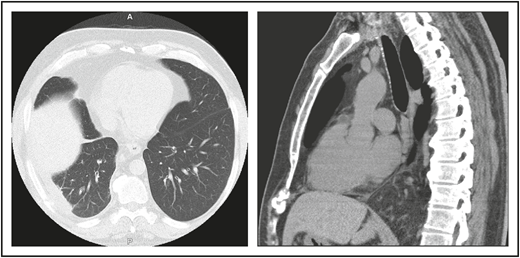 (A) The patient in clinical case 1 with several episodes of severe autoimmune hemolytic anemia was only diagnosed with CVID after he had bacterial pneumonia and developed an empyema. (B) Lateral view shows the posterior empyema collection.