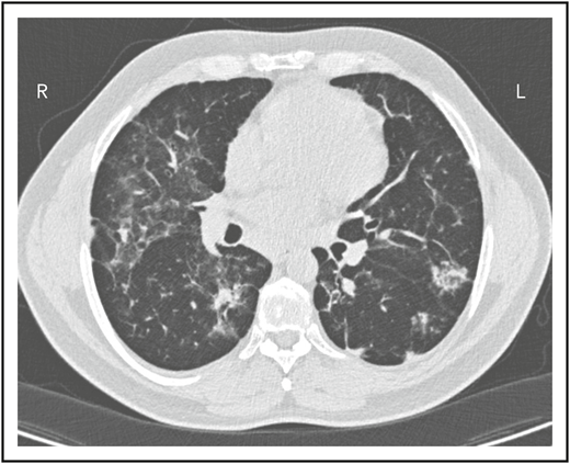 The patient in clinical case 2 had a slow decline in lung function due to his immune defect, but this was assumed to be due to sarcoidosis. Chest computed tomography showed ground-glass opacities with numerous nodules, hilar lymphadenopathy, and bronchiectatic changes. With granuloma on biopsy, these changes were consistent with granulomatous lymphocytic interstitial lung disease.