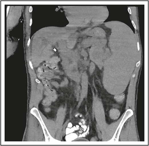 The patient in clinical case 3 was concerned because after he received chemotherapy for a presumed lymphoma, his spleen remained large. However, this is typical in patients with CVID.