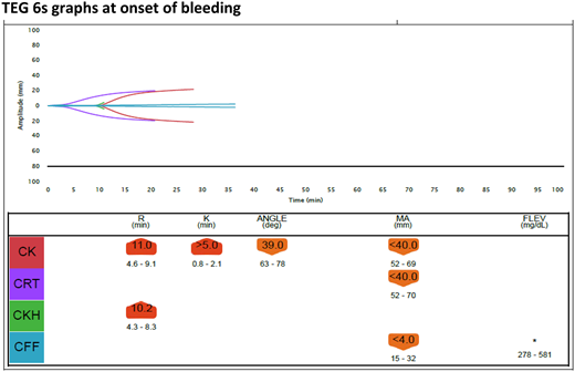 TEG 6s graphs at onset of bleeding.