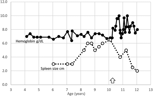 Case 1 depiction. In a patient with HbE β thalassemia (case 1), progressive increase in spleen size and reduced growth velocity led to start of regular transfusions (arrow). Transfusions led to reduction in splenomegaly over the following 2 years.