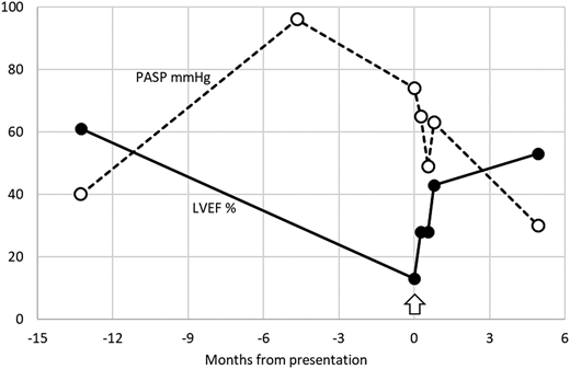 Case 2 depiction. In a transfusion-dependent patient with HbE β thalassemia (case 2), splenectomy was followed by discontinuation of regular transfusions. Fifteen years later, severe pulmonary arterial hypertension and congestive heart failure developed. These pathological changes were reversed by resumption of transfusions (arrow) and supportive care. LVEF%, left ventricular ejection fraction (percent); PASP, pulmonary artery systolic pressure.