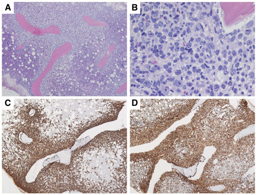 Bone marrow biopsy pathologic images of patient 1. (A) Low power view showing extensive paratrabecular aggregates of lymphoma cells; (B) higher power view showing large polylobate centroblasts that are CD20 positive (C) and CD10 positive (D). (Images courtesy of Dr. Girish Venkataraman, University of Chicago.)