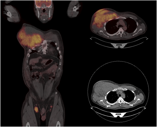 Patient with FL transforming to HGBL-DHL/THL, showing massive infiltration of the right chest wall and axillary adenopathy.