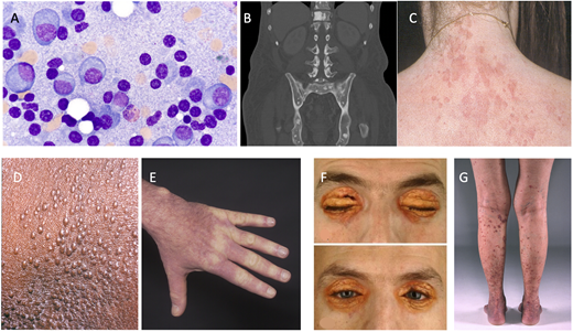 Part of the monoclonal gammopathy of clinical significance spectrum. (A) Bone marrow plasma cells (original magnification, 100×). (B) Osteosclerotic lesions of POEMS syndrome (polyradiculoneuropathy, organomegaly, endocrinopathy, monoclonal plasma cell disorder, and skin changes). (C) Schnitzler syndrome. (D and E) Scleromyxedema. (F) Necrobiotic xanthogranuloma. (G) Cryoglobulinemia vasculitis.