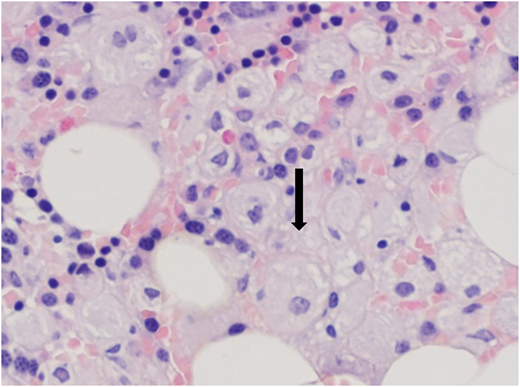 Bone marrow trephine biopsy showing typical “Gaucher cells” (arrow).