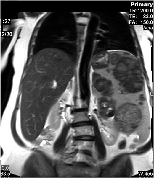 Abdominal magnetic resonance imaging showing hepatosplenomegaly with prominent intrasplenic lesions.