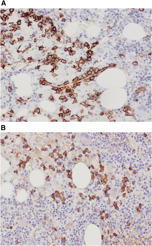 (A) Bone marrow trephine biopsy showing CD138 staining of plasma cells. (B) Bone marrow trephine biopsy showing κ-light chain staining.
