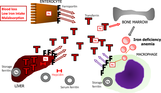 Schematic representation of the regulation of iron metabolism in absolute ID. Iron depletion occurs commonly and is related to associations among blood loss, low dietary iron intake, and malabsorption. Low iron decreases hepcidin (H) production, allowing for ferroportin (F) activity in duodenal enterocytes, to transfer iron (Fe) absorbed from the diet to transferrin (T), and mobilize iron stored in hepatocytes and macrophages. With progressive iron depletion, the intracellular store of ferritin (iron-rich) is depleted, and serum ferritin (iron-poor) release by macrophages decreases proportionately, along with a progressive decrease in circulating transferrin-bound iron. Low iron also upregulates hepatic production of transferrin, resulting in high TIBC, contributing to low TSAT. Lack of iron available to the BM eventually manifests as hypochromic, microcytic anemia.