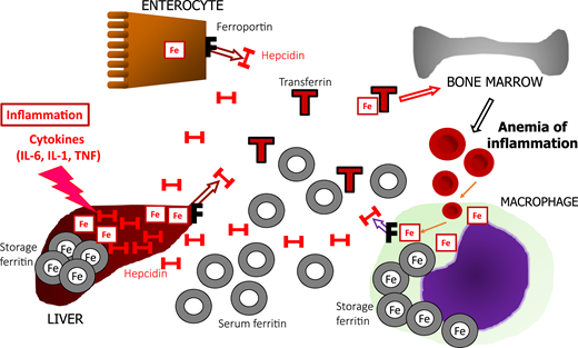 Schematic representation of the regulation of iron metabolism in FID in CICs. Inflammation with increased cytokine production causes upregulation of liver hepcidin (H), which binds to ferroportin (F). Enterocytes are prevented from exporting absorbed iron (Fe) to transferrin (T) in the bloodstream. In hepatocytes and macrophages, iron is also trapped intracellularly and is stored as iron-rich ferritin, whereas macrophages increase iron-poor serum ferritin in circulation. High intracellular iron also downregulates transferrin production, lowering TIBC. Iron release is so restricted that the decrease in serum iron still lowers TSAT despite low TIBC. Iron restriction eventually leads to the anemia of inflammation. Both ID and FID have hypoferremia but low TIBC, and high ferritin characterizes FID.