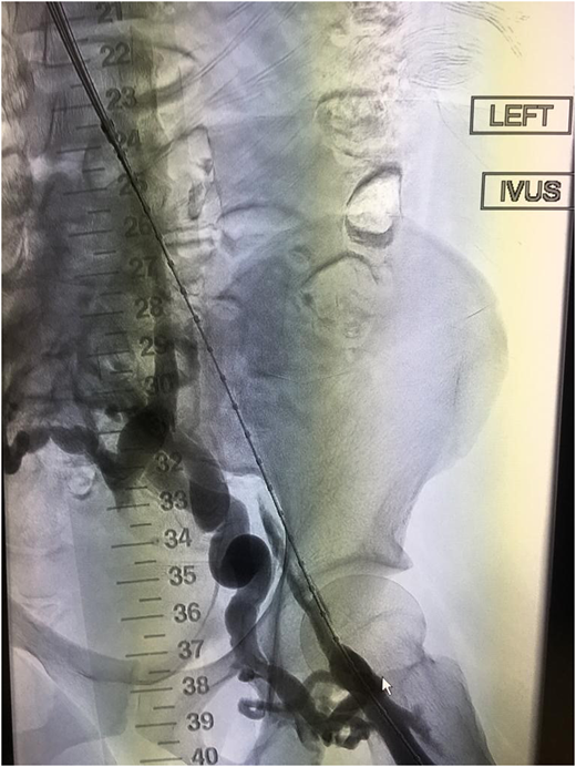 Example of thrombosed iliofemoral lesion with collateralization before venous stenting.