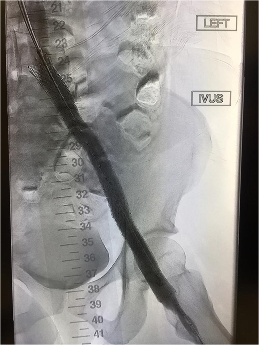 Improved vascular flow after venous stenting using the Abre stent (Medtronic).