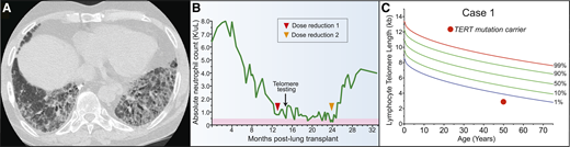 Pulmonary fibrosis is the most common short telomere manifestation. (A) Typical appearance of telomere-related IPF characterized on CT by honeycombing in the lung bases. (B) Schematic showing progressive neutropenia after lung transplant that improved after immunosuppressant regimen was attenuated. (C) Lymphocyte telomere length by flow cytometry and fluorescence in situ hybridization (flowFISH) in representative case.