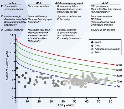 Age-dependent manifestations of the short telomere syndromes. A schematic telogram demonstrating the typical ranges of telomere length shortening by age of symptomatic disease onset. The threshold for clinically relevant telomere shortening is age and context dependent. Highlighted on top are the predominant manifestations in each of four age groups ordered by prevalence (primary, secondary, and tertiary). Telomere length displays a normal distribution in the population that is defined by the percentile lines labeled on the right. The telomere length is representative here of both total lymphocyte and granulocyte telomere lengths. Each dot represents one patient adapted from symptomatic patients included in Schratz et al.4 *“Mucosal strictures” is a general term that encompasses mucosal defects affecting multiple systems, including lacrimal duct stenosis, esophageal stenosis/strictures/webs, and urethral stenosis/stricture/phimosis. A-V, arteriovenous; synd., syndrome.