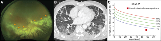 Infectious complications can precede onset of bone marrow failure in the short telomere syndromes. (A) Wide-field fundus photograph of CMV retinitis with intraretinal whitening (orange arrowheads) and necrosis along the retinal vasculature and progressing centrifugally. Image generously provided by Dr. Yonwook Kim of the Boston University Medical Center Department of Ophthalmology. (B) Chest CT image showing pleura-based patchy ground-glass opacities and interlobular septal thickening in a patient who developed P. jirovecii pneumonia in the background of interstitial lung disease and CMV retinitis that was ultimately fatal. (C) Lymphocyte telomere length by flowFISH in a patient with telomere-mediated primary T-cell immunodeficiency manifesting in fatal opportunistic infections.