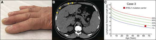 Clubbing and dyspnea can be a presenting feature of telomere-mediated hepatopulmonary syndrome. (A) Image of digital clubbing typically seen. (B) Abdominal CT image showing liver with nodular edges (yellow arrowheads) and secondary splenomegaly due to portal hypertension. (C) The lymphocyte telomere length by flowFISH in older patients with short telomere syndrome presenting over age 60 overlaps with the lower decile of the normal range.