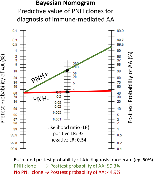 The Bayesian (Fagan's) nomogram demonstrating the pretest and posttest probability of having a diagnosis of immune-mediated AA based on PNH flow cytometry results. PNH clones have a near 100% positive predictive value for the diagnosis of immune-mediated AA, with a positive LR of approximately 92 for immune-mediated AA.8 Shown is an example corresponding to Case 2 in the text. To apply the nomogram tool, one first has to estimate the pretest probability of AA based on the clinical presentation. This previously healthy patient developed pancytopenia in young adulthood without any physical examination findings or family history suggestive of a congenital marrow failure disorder. Based on this presentation, her pretest probability of immune-mediated acquired AA is estimated as moderate to high. The green line shows the results for a conservative estimate of a moderate (approximately 60%) pretest probability of AA, crossing at the positive LR of 92. Detection of a PNH clone increases the posttest probability of AA to 99.3%, allowing to confidently establish the diagnosis of immune-mediated AA and initiate appropriate therapy. Importantly, a negative PNH test would not significantly change the pretest probability. Starting with a pretest probability of 60%, a negative PNH test (shown by the red line crossing at the negative LR of 0.54) will result in a posttest probability of 44.9%. The calculations for the Bayesian nomogram plot are based on Shah et al.8
