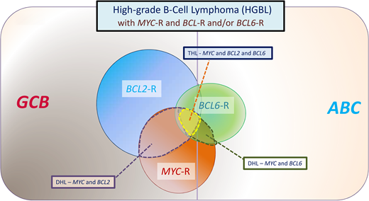 Category of aggressive B-cell lymphomas “HGBLs with MYC and BCL2 and/or BCL6 rearrangements” described in the 2016 revision to the World Health Organization classification of tumors of hematopoietic and lymphoid tumors. Most cases with MYC and BCL2 rearrangements are of GCB origin, whereas most cases with BCL6 rearrangements are of ABC origin. This category includes DH lymphomas, which involve MYC and BCL2 or MYC and BCL6, as well as THLs that involve MYC, BCL2, and BCL6. When translocated, MYC may have an IG or non-IG partner gene, with the former associated with an inferior outcome. In a large study, 7.9% of tumors with DLBCL morphology were assigned to HGBL-DHL/THL, composing 13.3% of GCB and 1.7% of ABC DLBCL.30