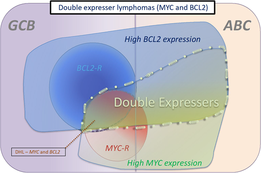 Categories of double-expresser lymphomas. These are typically cases that have a high-protein expression of MYC and BCL2. Most DPE cases that are associated with rearrangements of MYC and BCL2 are of GCB origin, whereas most cases that do not harbor these rearrangements are of ABC origin. The proportion of DLBCL cases that are double expressers has been calculated at between 21% and 44% across various studies.31