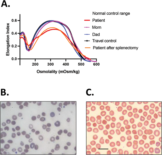 HS.(A)Ektacytometry of blood samples from the patient before and after splenectomy and from his parents. The patient had AR HS due to compound heterozygosity of SPTA1 c.4295del (p.L1432*), shared with the mom, and SPTA1 c.4339-99C>T, shared with the dad. The dad and the proband were also found to carry the PIEZO1 VUCS c.6205G>A (p.Val2069Met). The parents had a normal ektacytometry with no evidence of xerocytosis for the father, offering reassurance that the PIEZO1 VUCS is benign, while the patient after splenectomy had a typical HS curve. Before splenectomy, the patient was chronically transfused. Ektacytometry at that time was performed at a nadir before the next transfusion and 2 months after a previous one. Transfused RBCs have obviously modified the curve, giving a falsely normal Omin (ie, the hypotonic osmolality where the elongation index is minimal). The value of Omin provides information on the initial surface-to-volume ratio of the cell sample. A shift to the right reflects a decrease in the surface area/volume ratio and corresponds to increased osmotic fragility. (B) Blood smear of the patient about 18 months post partial splenectomy before starting to require transfusions again, demonstrating significant anisopoikilocytosis and polychromasia as well as many spherocytes, typical for AR SPTA1-associated HS. (C) Blood smear of the patient 5 years after total splenectomy, stable and without need of transfusions since the time of that surgery. Moderate anisopoikilocytosis and several spherocytes are still noted. Scale bar = 14 mm. Details on the ektacytometry assay and parameters can be found at https://www.cincinnatichildrens.org/service/c/cancer-blood/hcp/clinical-laboratories/erythrocyte-diagnostic-lab/ektacytometry.